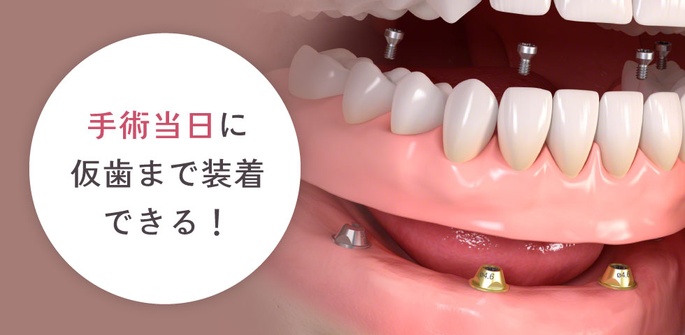 休憩後、仮歯の装着