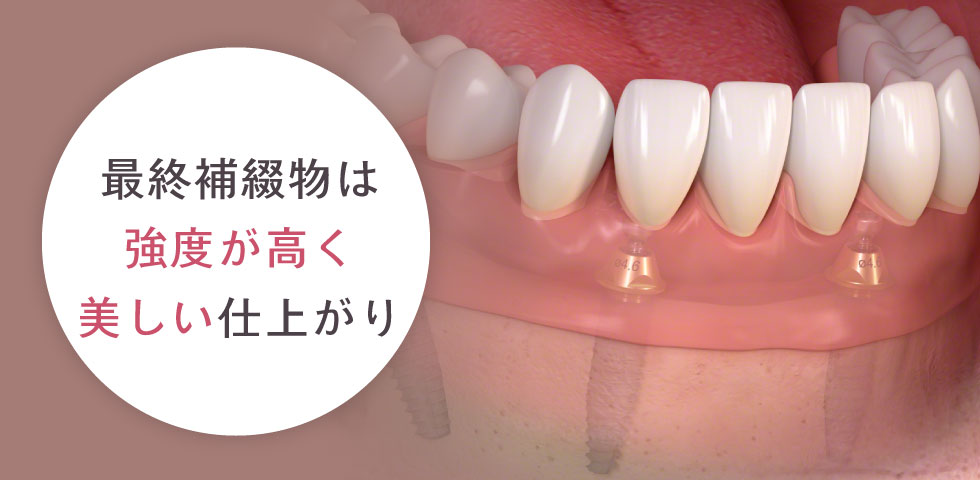 人工歯（ブリッジ）の装着