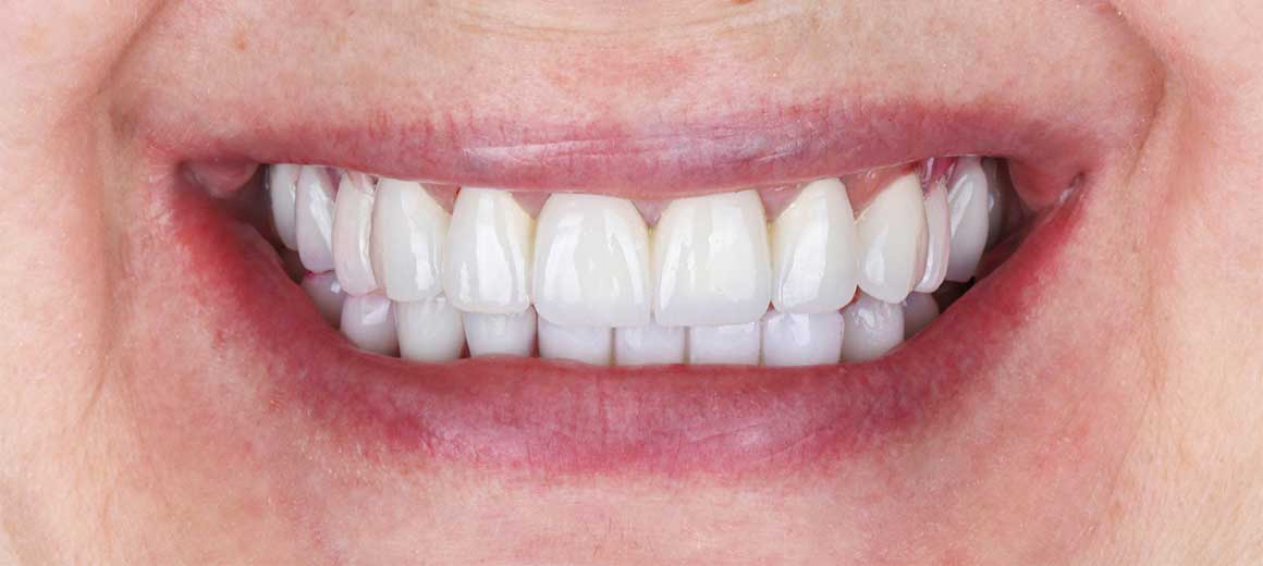 オールオン4は手術したその日に狩場が入ります