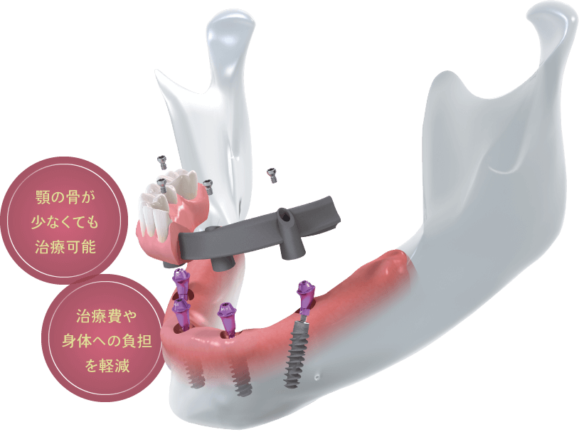 顎の骨が少なくても治療可能 治療費や身体への負担を軽減